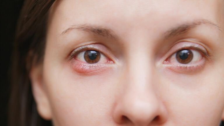 N&auml;&auml;r&auml;nn&auml;ppy on rauhasen tukkeumasta johtuva tulehdus yl&auml;- tai alaluomessa